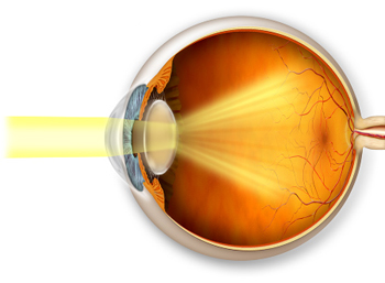 Cataract Symptoms 