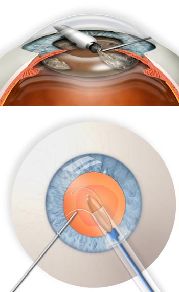 Cataract Surgery